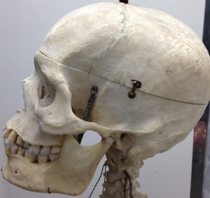 The cranium is an un-yielding house for the brain. Even the smallest bit of swelling in the brain can be a problem because the bony cranium does not expand.