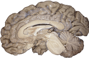The pineal gland is inside the cranium but outside the brain, inside the dura but outside the pia. No kidding!!