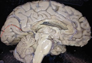 The calcarine sulcus is marked by a dashed red line on this image of the medial surface of the cortex. The upper bank of the visual cortex carries information about the lower half of the contralateral (other side) visual world and the lower bank of the visual cortex carries information about the upper half of the contralateral visual world.