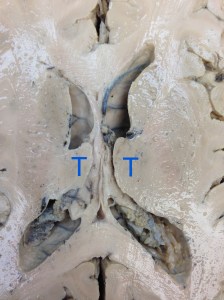 This is a horizontal section throught the thalamus (T). In this image, up is anterior. Many other structures are also visible, including the lateral ventricles, choroid plexus, caudate, internal capsule, corpus calossum and more.