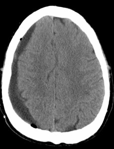 This is an image of a bleed provided by a reader. The owner of this brain fell off his bike and hit his head. He only developed symptoms 3 months later. He went to the hospital and this slowly developing bleed was revealed. He was lucky.
