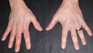 ParadoxicalVasodilation